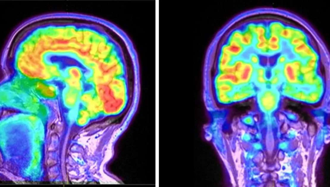 PET Scan